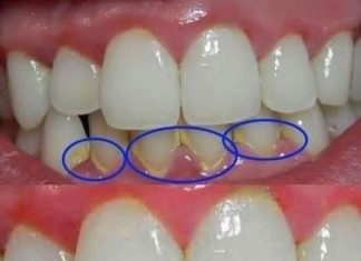 Remove dental plaque in 5 minutes naturally, without going to the dentist. Remove dental plaque in 5 minutes naturally, without going to the dentist. - featured image
