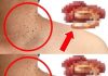 The Surprising Culprit Behind Skin Tags: One Common Food to Watch Out For The Surprising Culprit Behind Skin Tags: One Common Food to Watch Out For - featured image