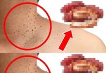 The Surprising Culprit Behind Skin Tags: One Common Food to Watch Out For The Surprising Culprit Behind Skin Tags: One Common Food to Watch Out For - featured image