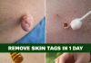 Best Natural Home Remedies To Safely Remove Skin Tags Best Natural Home Remedies To Safely Remove Skin Tags - featured image