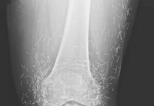 Doctors Stunned After Looking At This X-Ray Of Woman Suffering Joint Pain Doctors Stunned After Looking At This X-Ray Of Woman Suffering Joint Pain - featured image