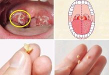 Here’s What You Need to Know About Tonsil Stones Here’s What You Need to Know About Tonsil Stones - featured image