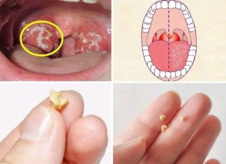 Here’s What You Need to Know About Tonsil Stones Here’s What You Need to Know About Tonsil Stones - featured image