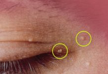 How to Get Rid of Milia: Those Annoying Fat Cysts How to Get Rid of Milia: Those Annoying Fat Cysts - featured image