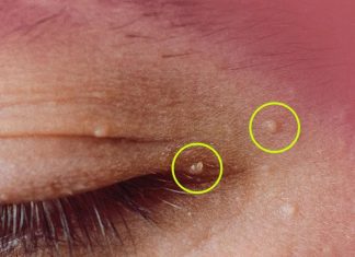 How to Get Rid of Milia: Those Annoying Fat Cysts How to Get Rid of Milia: Those Annoying Fat Cysts - featured image