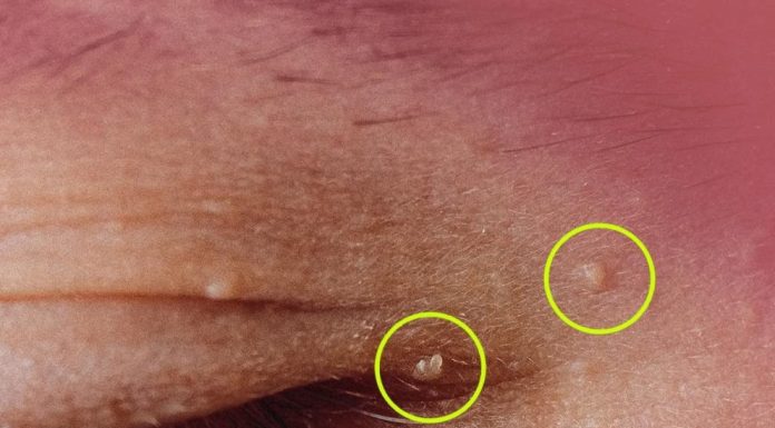 How to Get Rid of Milia: Those Annoying Fat Cysts How to Get Rid of Milia: Those Annoying Fat Cysts - featured image
