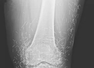 Doctors Stunned After Looking At This X-Ray Of Woman Suffering Joint Pain Doctors Stunned After Looking At This X-Ray Of Woman Suffering Joint Pain - featured image