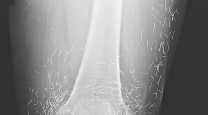 Doctors Stunned After Looking At This X-Ray Of Woman Suffering Joint Pain Doctors Stunned After Looking At This X-Ray Of Woman Suffering Joint Pain - featured image