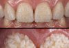 Can Rice Really Whiten Teeth? The Truth Behind This Viral Trick Can Rice Really Whiten Teeth? The Truth Behind This Viral Trick - featured image