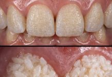Can Rice Really Whiten Teeth? The Truth Behind This Viral Trick Can Rice Really Whiten Teeth? The Truth Behind This Viral Trick - featured image