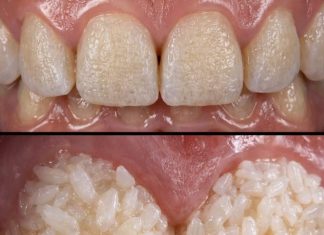 Can Rice Really Whiten Teeth? The Truth Behind This Viral Trick Can Rice Really Whiten Teeth? The Truth Behind This Viral Trick - featured image