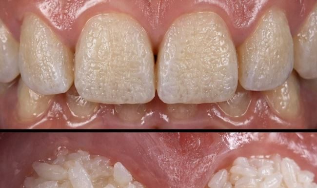 Can Rice Really Whiten Teeth? The Truth Behind This Viral Trick Can Rice Really Whiten Teeth? The Truth Behind This Viral Trick - featured image