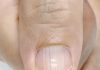 If you have these lines on your nails after 40, it is a clear sign that.. If you have these lines on your nails after 40, it is a clear sign that.. - featured image