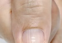 If you have these lines on your nails after 40, it is a clear sign that.. If you have these lines on your nails after 40, it is a clear sign that.. - featured image