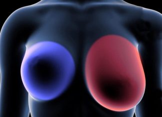 Breast cancer: 4 early signs every woman should know. Breast cancer: 4 early signs every woman should know. - featured image