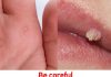 Natural Wart Removal: Simple Methods That Might Actually Work Natural Wart Removal: Simple Methods That Might Actually Work - featured image