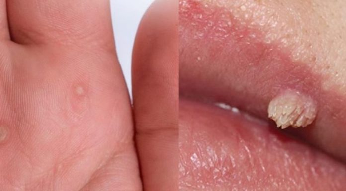 Natural Wart Removal: Simple Methods That Might Actually Work Natural Wart Removal: Simple Methods That Might Actually Work - featured image