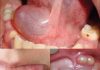 Hidden Dangers in Your Mouth — Early Signs of Oral Cancer You Should Never Ignore Hidden Dangers in Your Mouth — Early Signs of Oral Cancer You Should Never Ignore - featured image