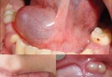 Hidden Dangers in Your Mouth — Early Signs of Oral Cancer You Should Never Ignore Hidden Dangers in Your Mouth — Early Signs of Oral Cancer You Should Never Ignore - featured image