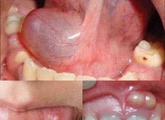 Hidden Dangers in Your Mouth — Early Signs of Oral Cancer You Should Never Ignore Hidden Dangers in Your Mouth — Early Signs of Oral Cancer You Should Never Ignore - featured image