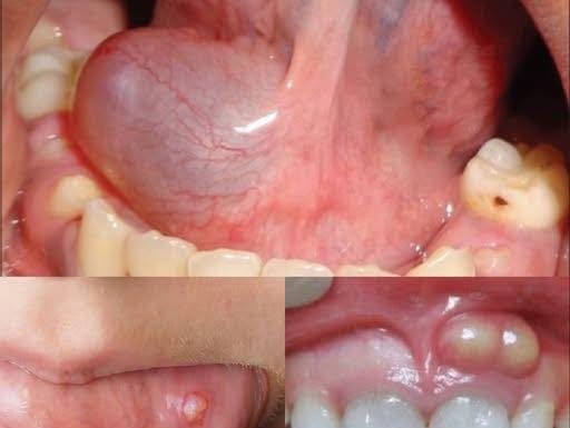 Hidden Dangers in Your Mouth — Early Signs of Oral Cancer You Should Never Ignore Hidden Dangers in Your Mouth — Early Signs of Oral Cancer You Should Never Ignore - featured image