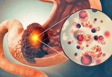 Doctors Reveal the One Blood Type Which Has the Lowest Risk of Ca.ncer Doctors Reveal the One Blood Type Which Has the Lowest Risk of Ca.ncer - featured image