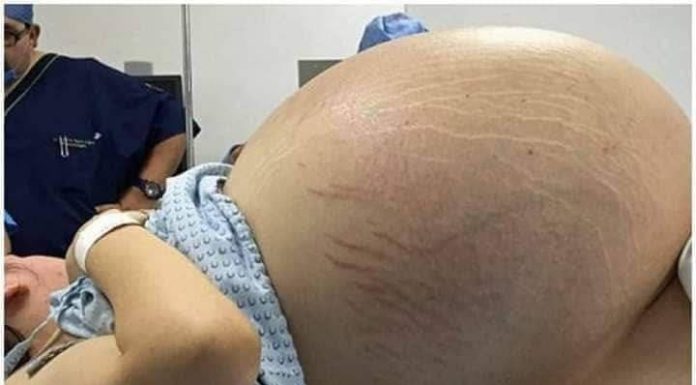 Tears of Joy Turn to Shock: A Pregnant Woman Expecting Triplets Leaves Doctors Stunned by a Terrifying Discovery During C-Section Tears of Joy Turn to Shock: A Pregnant Woman Expecting Triplets Leaves Doctors Stunned by a Terrifying Discovery During C-Section - featured image