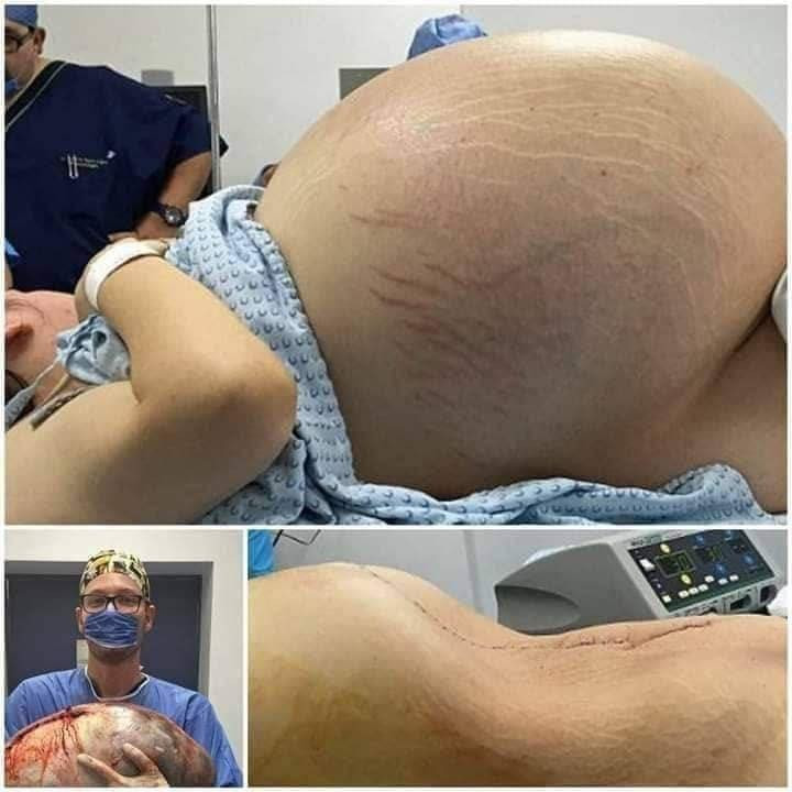 Tears of Joy Turn to Shock: A Pregnant Woman Expecting Triplets Leaves Doctors Stunned by a Terrifying Discovery During C-Section - featured image Tears of Joy Turn to Shock: A Pregnant Woman Expecting Triplets Leaves Doctors Stunned by a Terrifying Discovery During C-Section - featured image